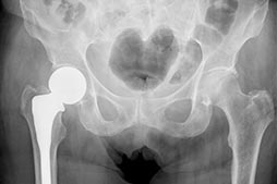 Hip Implants and replacement